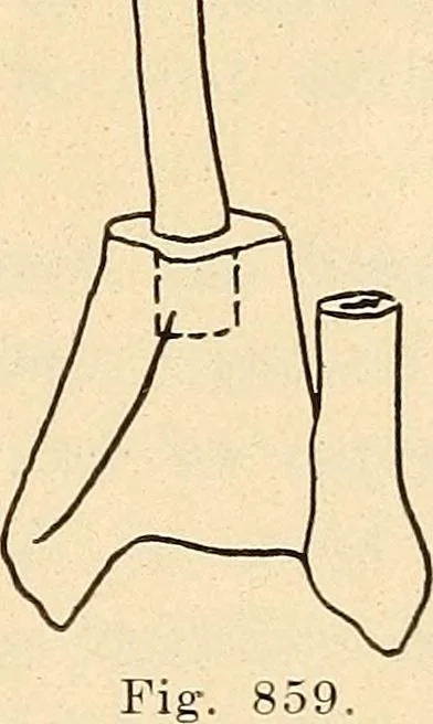 An illustration from Fractures and dislocations, diagnosis and treatment, 1915, leaf 816