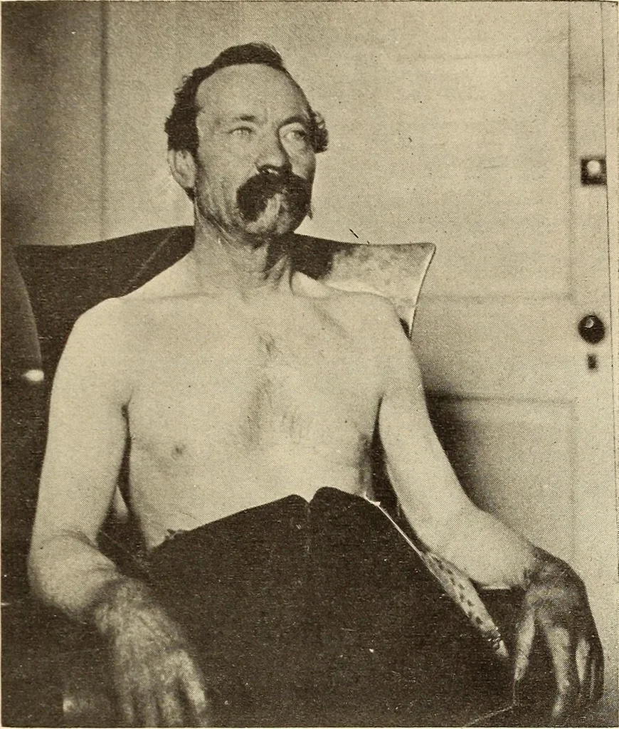 An illustration from Fractures and dislocations, diagnosis and treatment, 1915, leaf 84