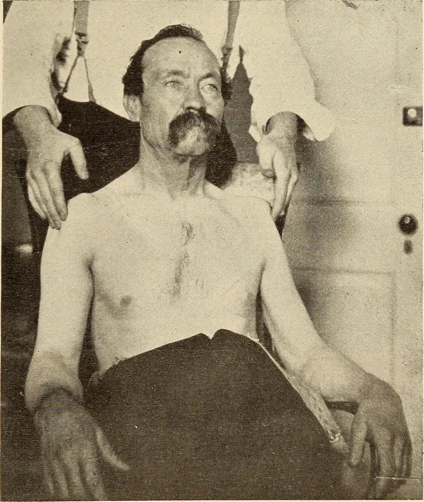 An illustration from Fractures and dislocations, diagnosis and treatment, 1915, leaf 84