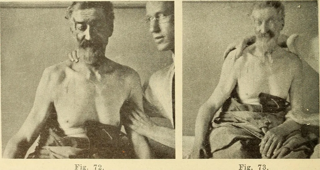 An illustration from Fractures and dislocations, diagnosis and treatment, 1915, leaf 87