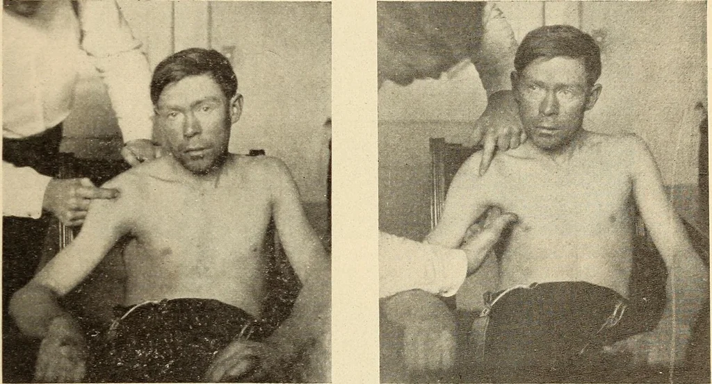 An illustration from Fractures and dislocations, diagnosis and treatment, 1915, leaf 88