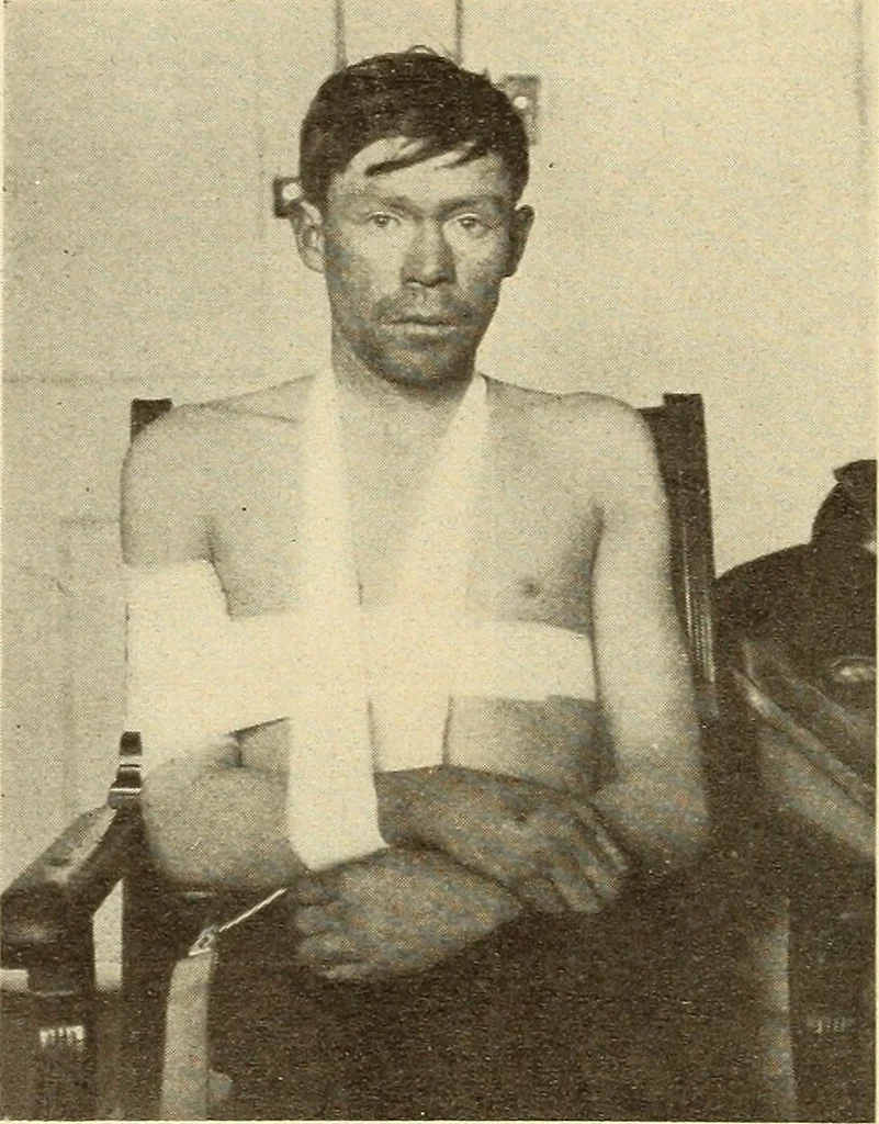 An illustration from Fractures and dislocations, diagnosis and treatment, 1915, leaf 89