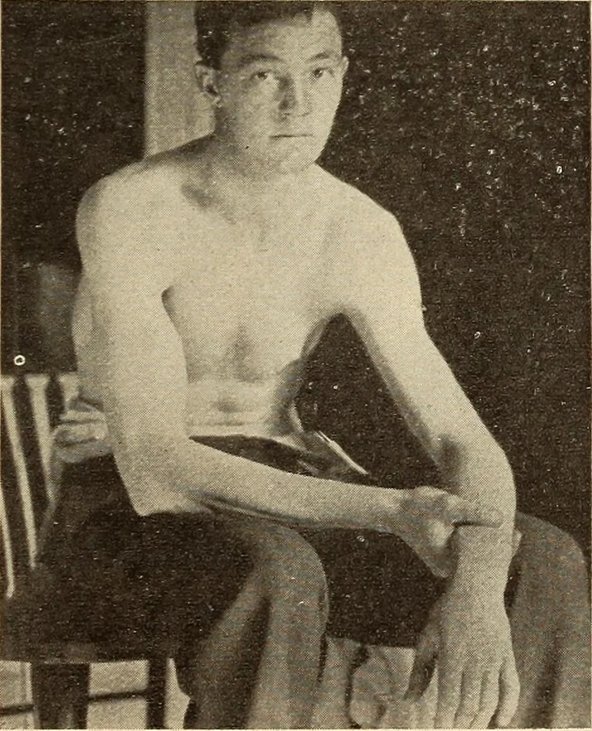 An illustration from Fractures and dislocations, diagnosis and treatment, 1915, leaf 90