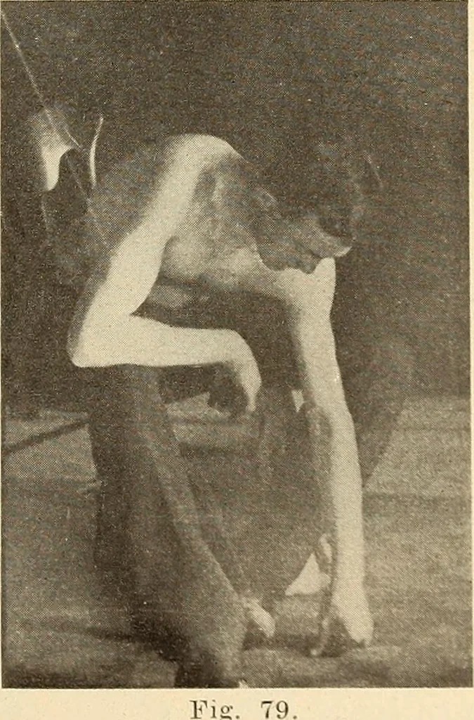 An illustration from Fractures and dislocations, diagnosis and treatment, 1915, leaf 90