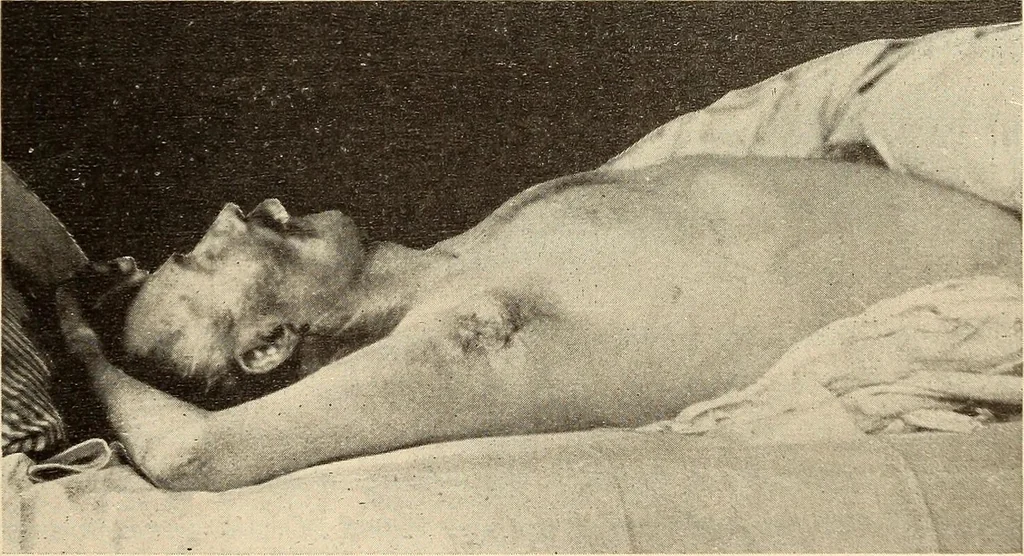 An illustration from Fractures and dislocations, diagnosis and treatment, 1915, leaf 92