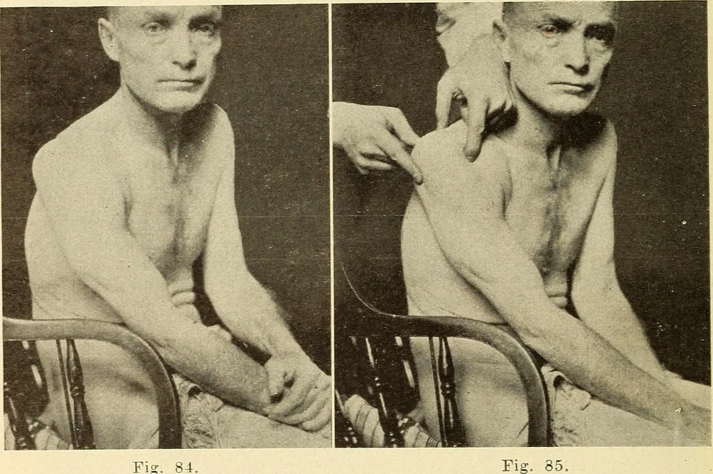 An illustration from Fractures and dislocations, diagnosis and treatment, 1915, leaf 93
