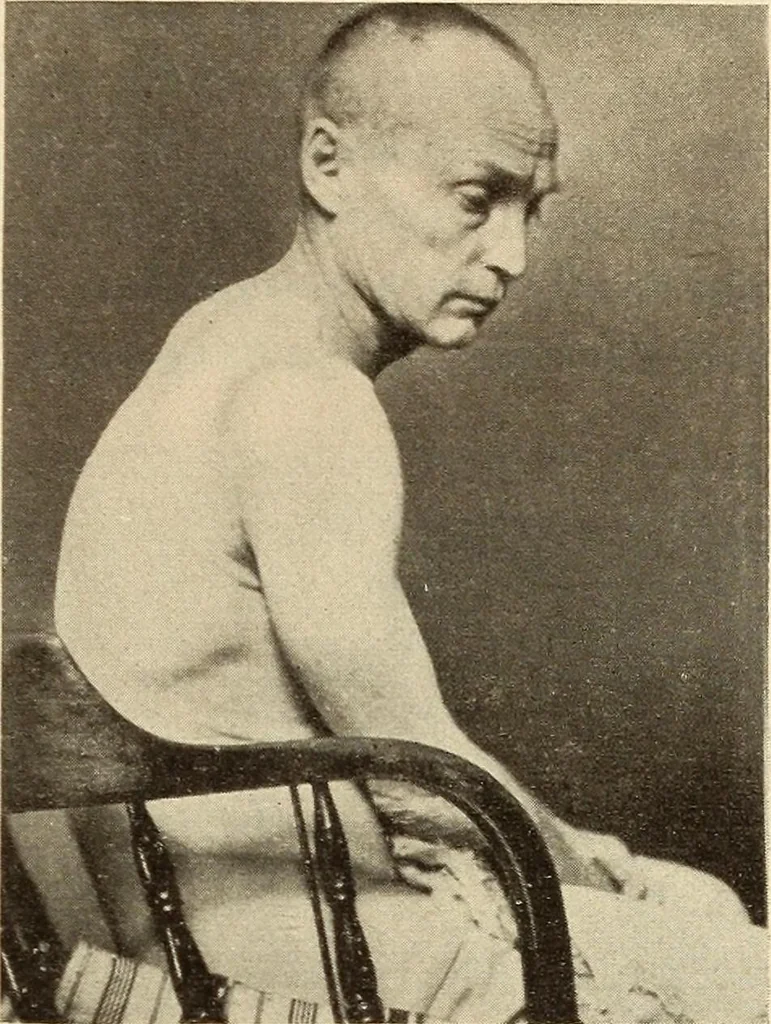 An illustration from Fractures and dislocations, diagnosis and treatment, 1915, leaf 94