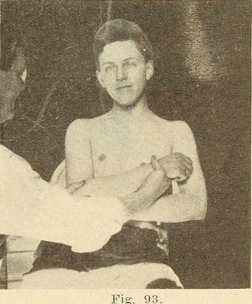 An illustration from Fractures and dislocations, diagnosis and treatment, 1915, leaf 98
