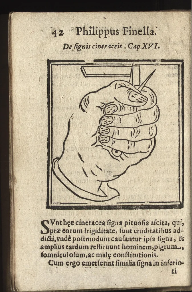 An illustration from De quatuor signis quae apparent in vnguibus manuum, 1649, leaf 43