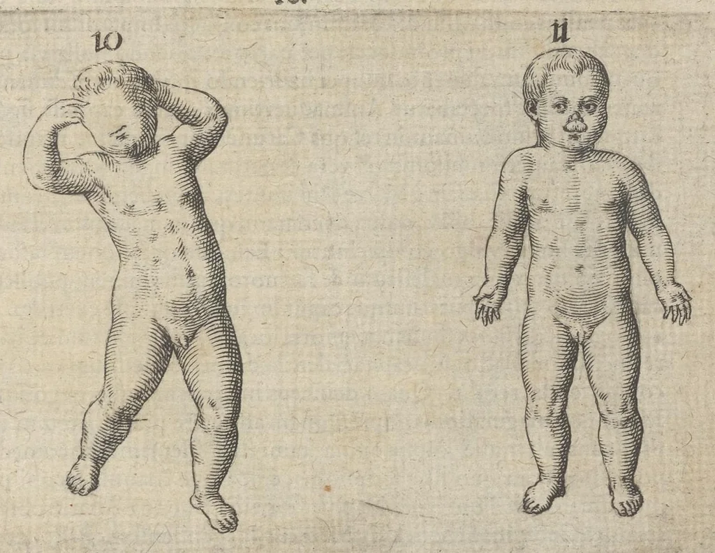An illustration from Monstrorum historia memorabilis : monstrosa humanorum partuum miracula : stupendis conformationum formulis ab vtero materno enata : viuis exemplis, obseruationibus, & picturis, referens : accessit analogicum argumentum de monstris brutis : Supplementi loco ad observationes medicas Schenkianas edita, 1609, leaf 22
