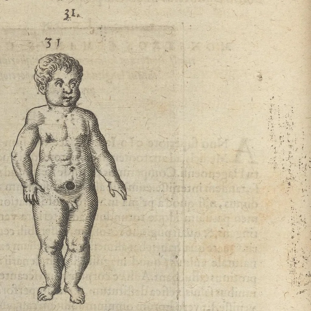 An illustration from Monstrorum historia memorabilis : monstrosa humanorum partuum miracula : stupendis conformationum formulis ab vtero materno enata : viuis exemplis, obseruationibus, & picturis, referens : accessit analogicum argumentum de monstris brutis : Supplementi loco ad observationes medicas Schenkianas edita, 1609, leaf 53