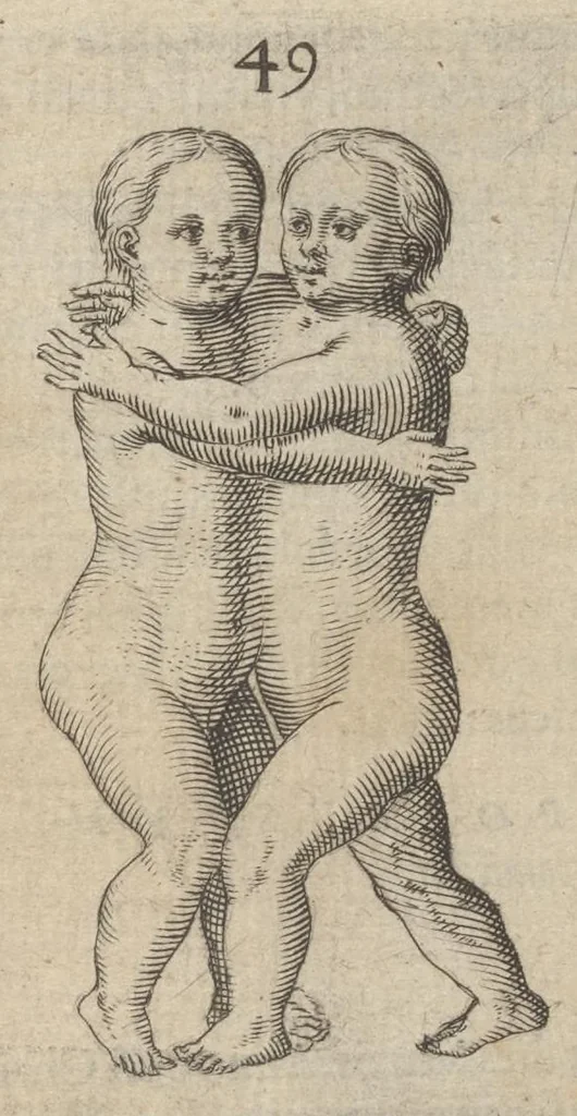 An illustration from Monstrorum historia memorabilis : monstrosa humanorum partuum miracula : stupendis conformationum formulis ab vtero materno enata : viuis exemplis, obseruationibus, & picturis, referens : accessit analogicum argumentum de monstris brutis : Supplementi loco ad observationes medicas Schenkianas edita, 1609, leaf 80
