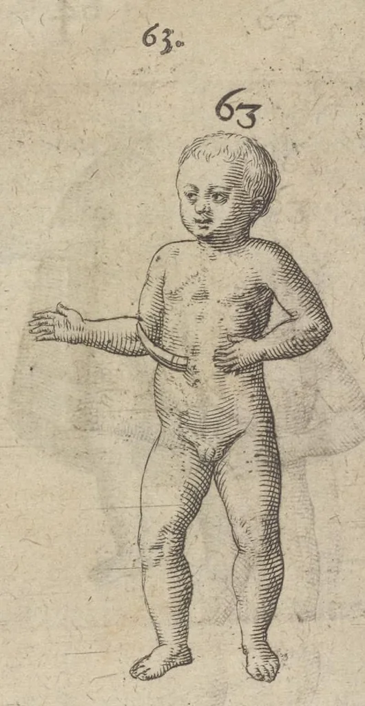 An illustration from Monstrorum historia memorabilis : monstrosa humanorum partuum miracula : stupendis conformationum formulis ab vtero materno enata : viuis exemplis, obseruationibus, & picturis, referens : accessit analogicum argumentum de monstris brutis : Supplementi loco ad observationes medicas Schenkianas edita, 1609, leaf 96