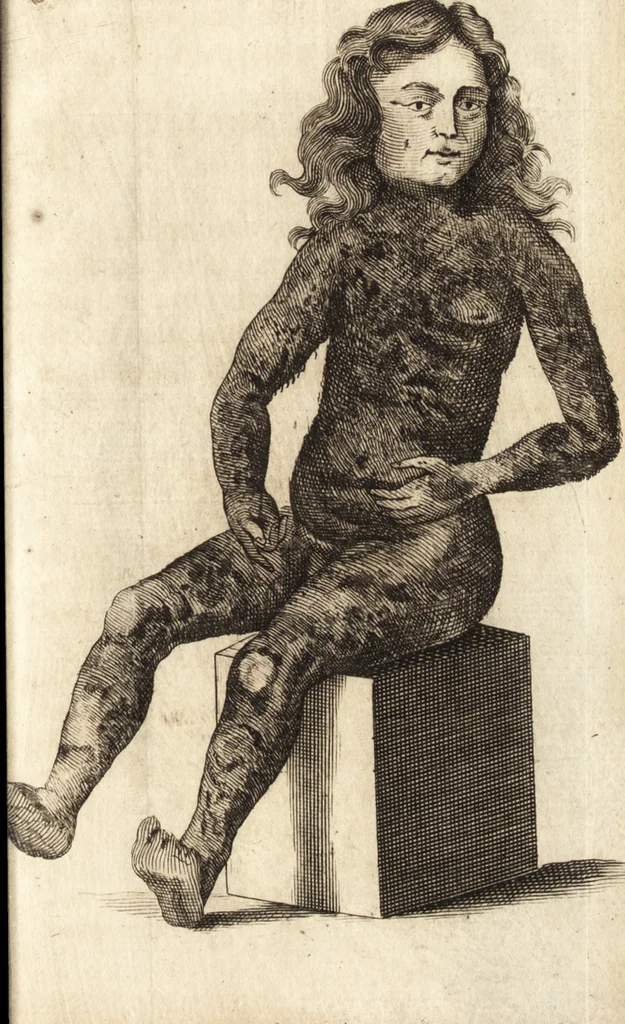 An illustration from C. Stalpartii vander Wiel medici Hagiensis Observationum rariorum medic. anatomic. chirurgicarum centuria prior : accedit De unicornu dissertatio : utraque tertia parte auctior, longeque emendatior, 1687, leaf 424