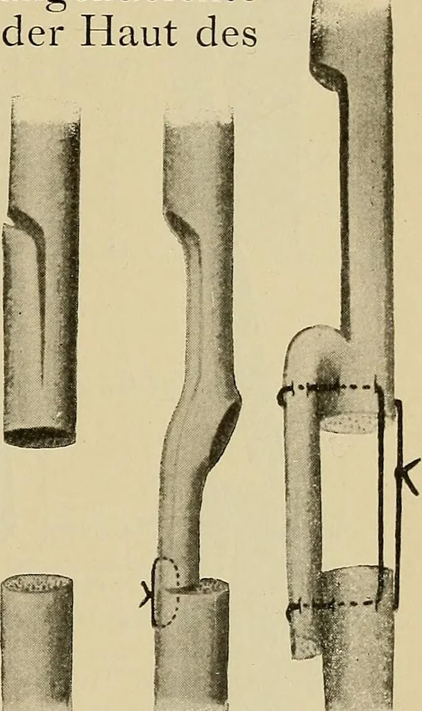 An illustration from Grundriss und Atlas der allgemeinen Chirurgie, 1905, leaf 111