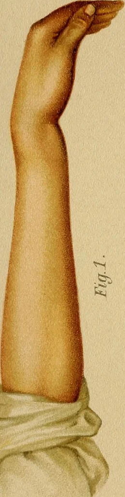An illustration from Grundriss und Atlas der allgemeinen Chirurgie, 1905, leaf 119