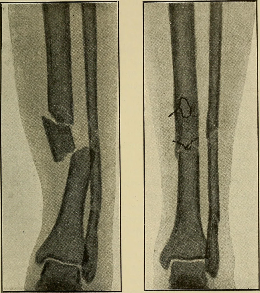 An illustration from Grundriss und Atlas der allgemeinen Chirurgie, 1905, leaf 133