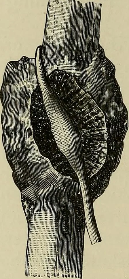 An illustration from Grundriss und Atlas der allgemeinen Chirurgie, 1905, leaf 136