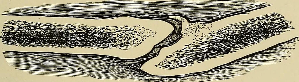 An illustration from Grundriss und Atlas der allgemeinen Chirurgie, 1905, leaf 137