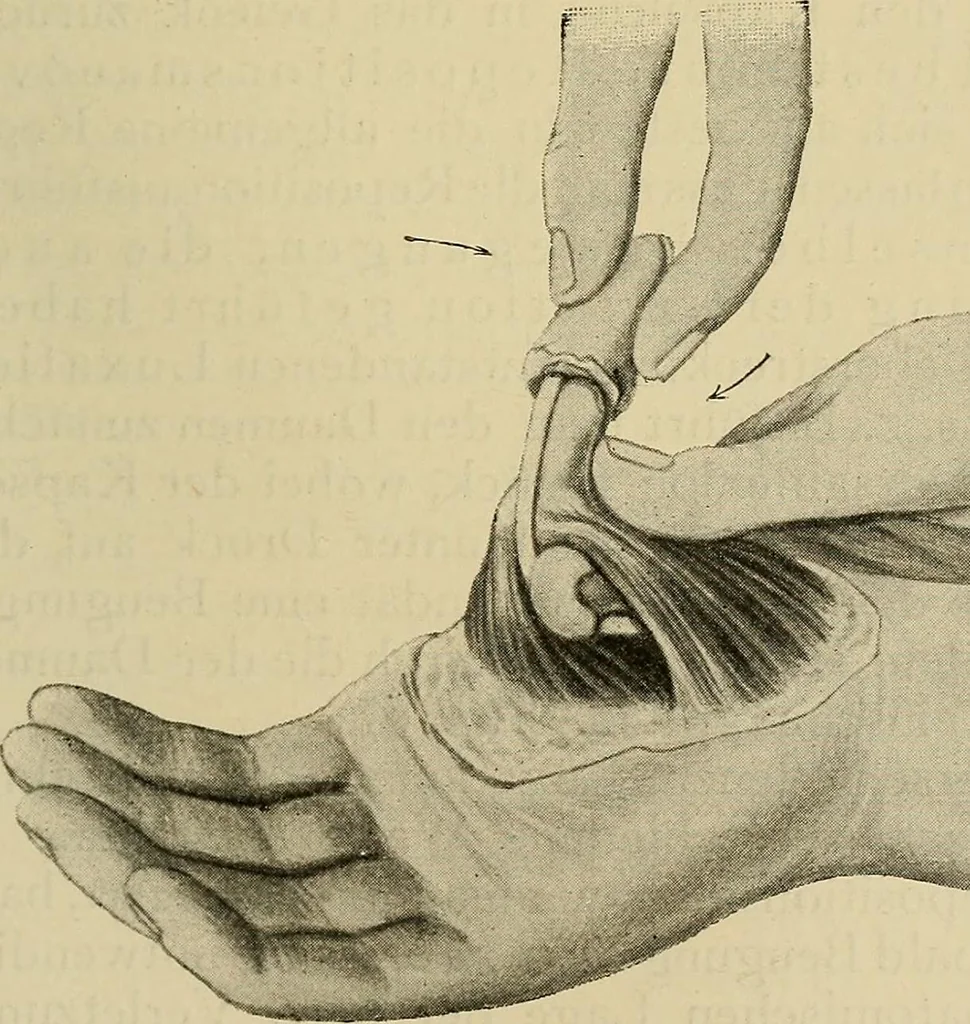 An illustration from Grundriss und Atlas der allgemeinen Chirurgie, 1905, leaf 151