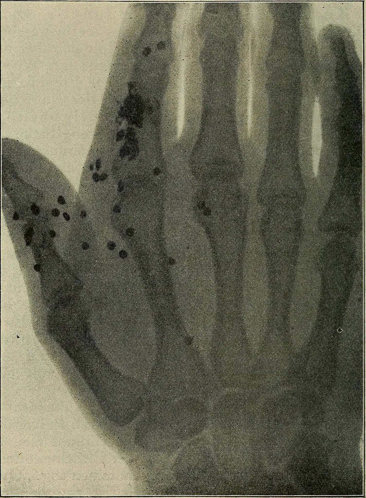 An illustration from Grundriss und Atlas der allgemeinen Chirurgie, 1905, leaf 176