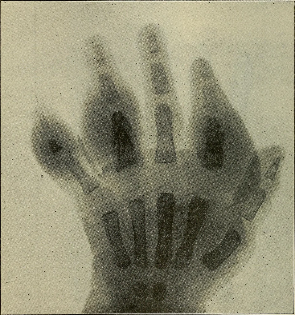 An illustration from Grundriss und Atlas der allgemeinen Chirurgie, 1905, leaf 348