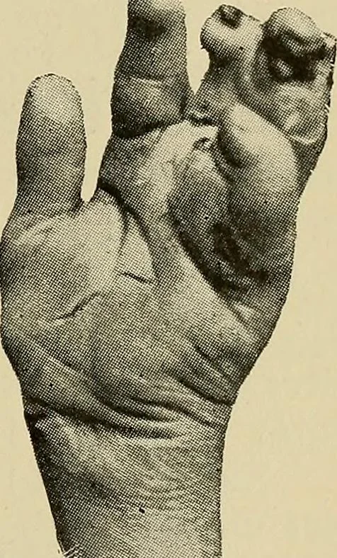 An illustration from Grundriss und Atlas der allgemeinen Chirurgie, 1905, leaf 361