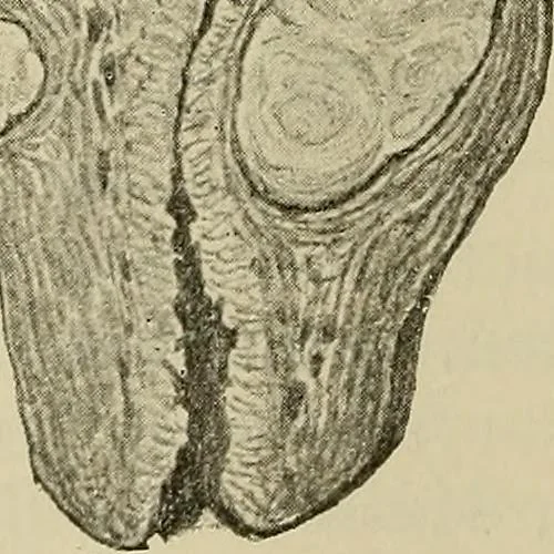 An illustration from Grundriss und Atlas der allgemeinen Chirurgie, 1905, leaf 412