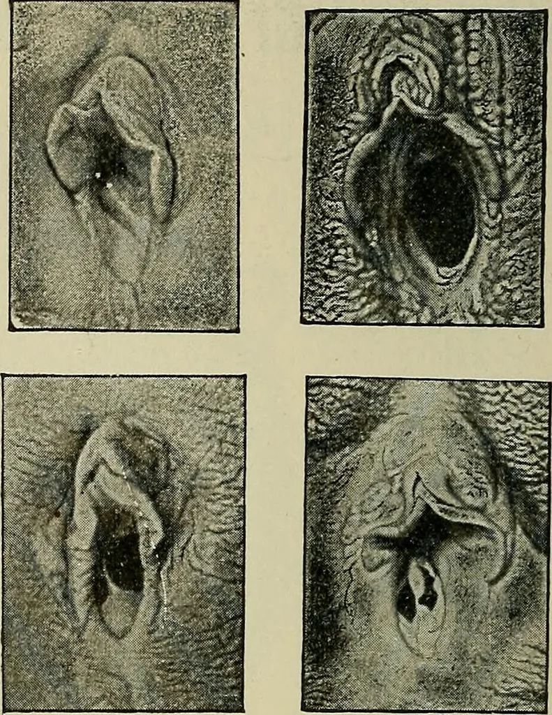 An illustration from Grundriss und Atlas der allgemeinen Chirurgie, 1905, leaf 502