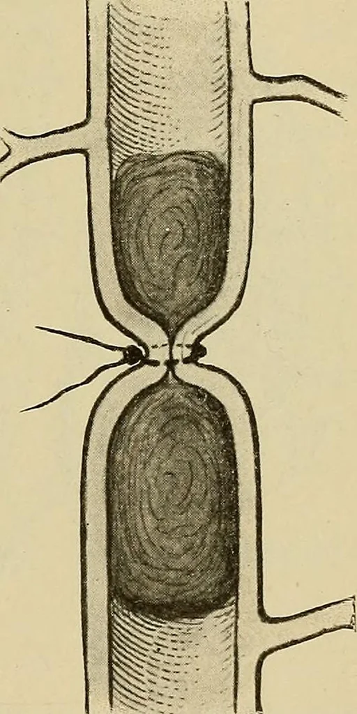 An illustration from Grundriss und Atlas der allgemeinen Chirurgie, 1905, leaf 71