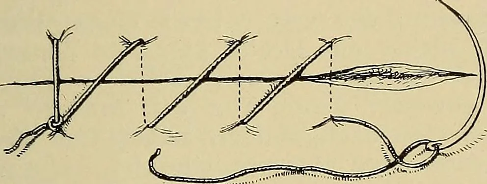 An illustration from Grundriss und Atlas der allgemeinen Chirurgie, 1905, leaf 77