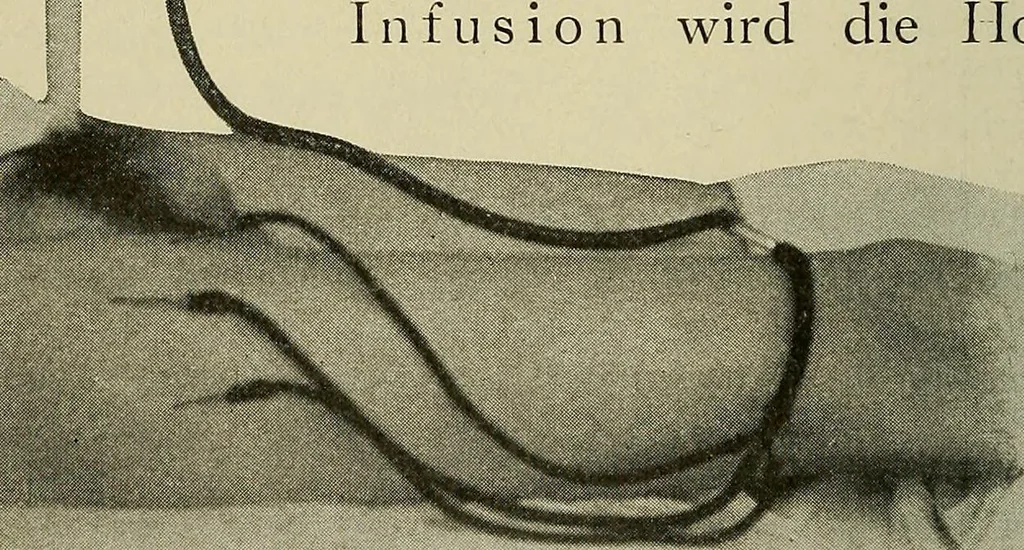 An illustration from Grundriss und Atlas der allgemeinen Chirurgie, 1905, leaf 92