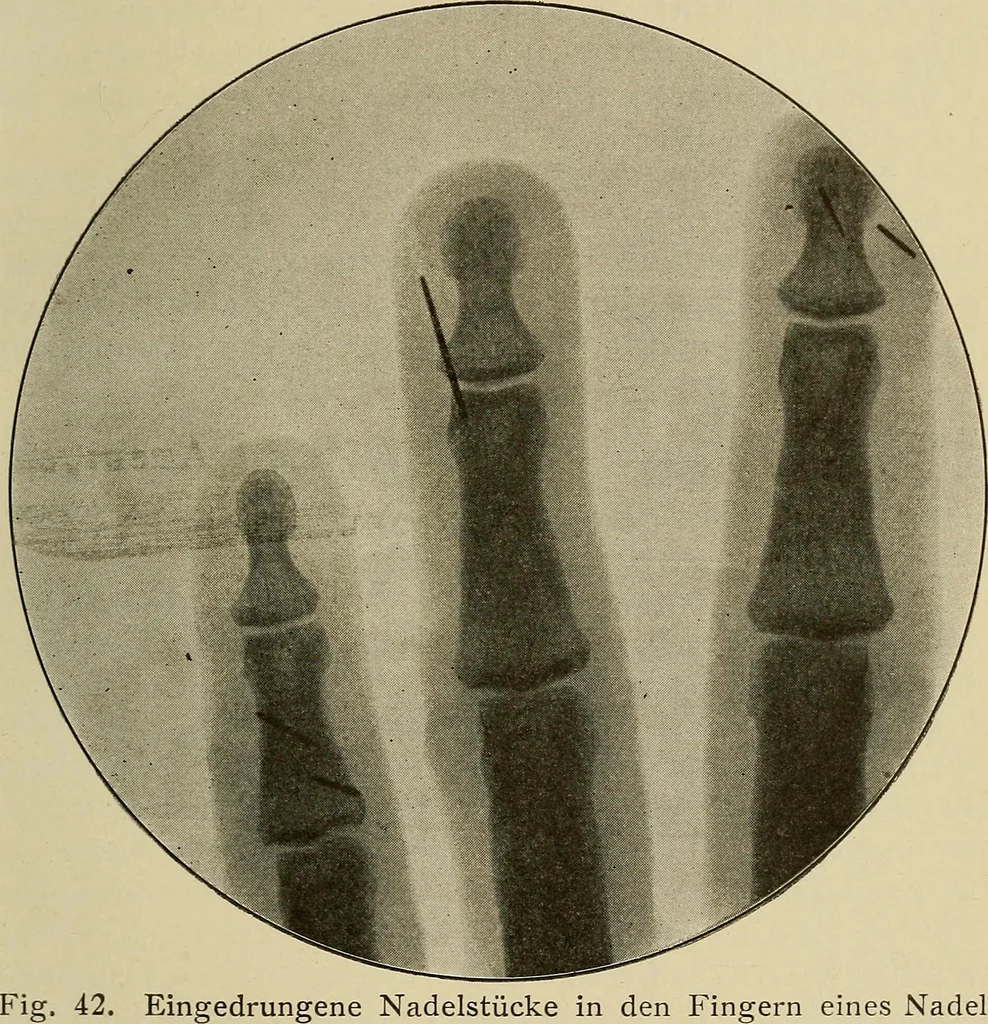 An illustration from Grundriss und Atlas der allgemeinen Chirurgie, 1905, leaf 95