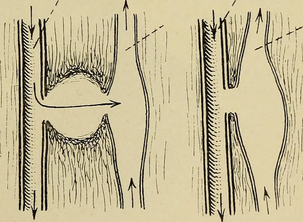 An illustration from Grundriss und Atlas der allgemeinen Chirurgie, 1905, leaf 97