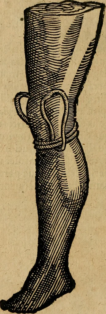 An illustration from Guilhelmi FabricI Hildani inclytae reipublicae Bernensis Helvet. medico-chirurgi ordinarii De gangraena et sphacelo, tractatus methodicus : in quo horum morborum differentiae, causae, signa, prognostica, ac denique methodica curatio continentur, 1617, leaf 167