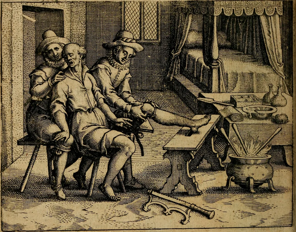 An illustration from Guilhelmi FabricI Hildani inclytae reipublicae Bernensis Helvet. medico-chirurgi ordinarii De gangraena et sphacelo, tractatus methodicus : in quo horum morborum differentiae, causae, signa, prognostica, ac denique methodica curatio continentur, 1617, leaf 169