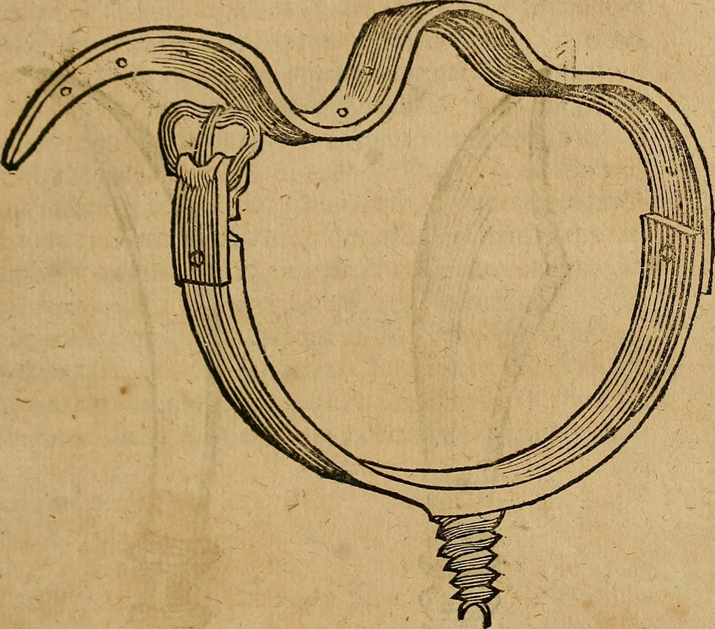 An illustration from Guilhelmi FabricI Hildani inclytae reipublicae Bernensis Helvet. medico-chirurgi ordinarii De gangraena et sphacelo, tractatus methodicus : in quo horum morborum differentiae, causae, signa, prognostica, ac denique methodica curatio continentur, 1617, leaf 172