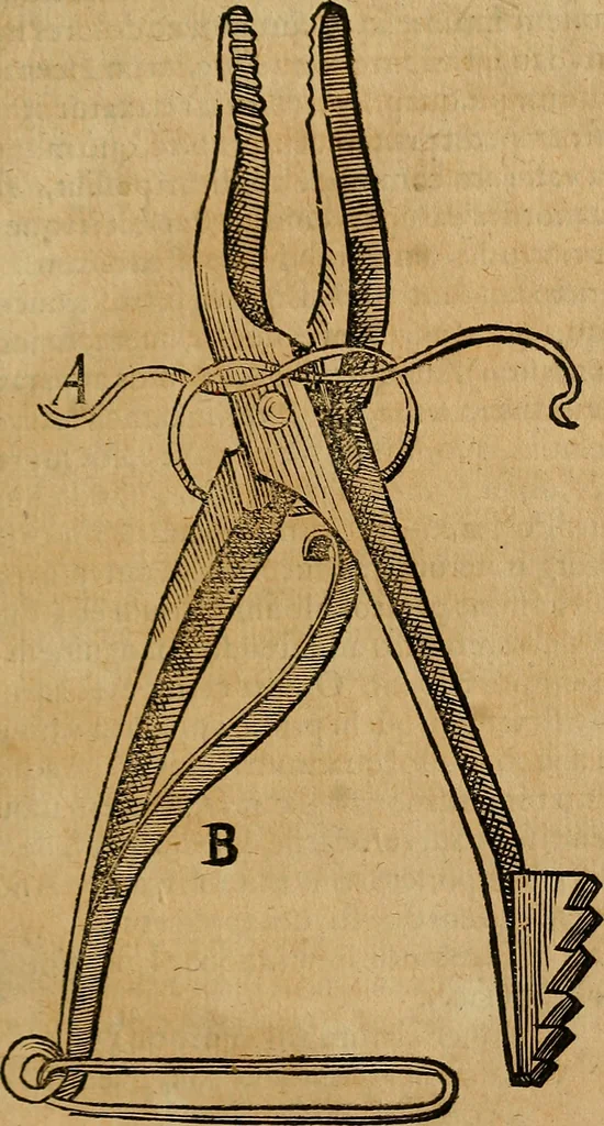 An illustration from Guilhelmi FabricI Hildani inclytae reipublicae Bernensis Helvet. medico-chirurgi ordinarii De gangraena et sphacelo, tractatus methodicus : in quo horum morborum differentiae, causae, signa, prognostica, ac denique methodica curatio continentur, 1617, leaf 188