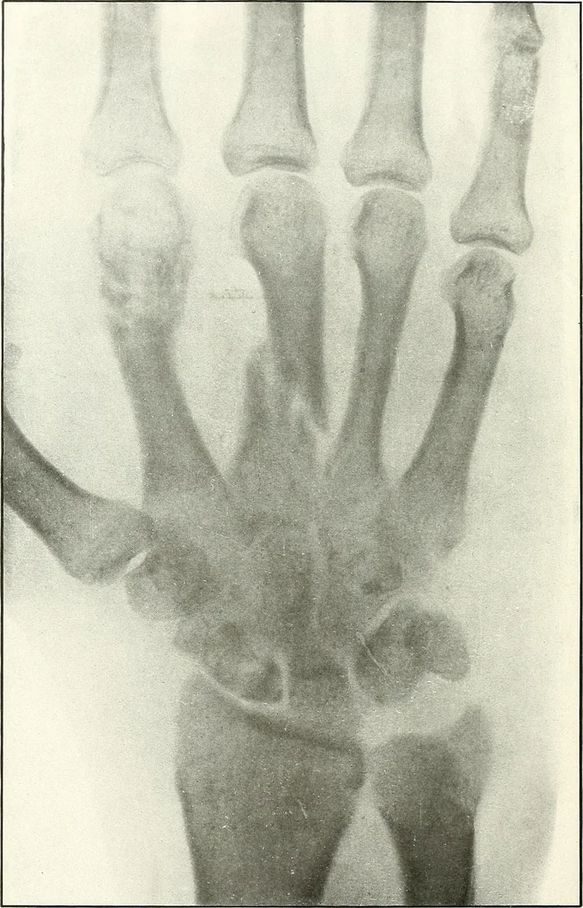 An illustration from Gunshot Roentgenograms : Acollection of Roentgenograms taken in Constantinople during the Turko-Balkan War, 1912-1913, illustrating some gunshot wounds in the Turkish Army, 1916, leaf 100