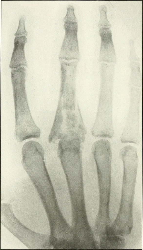 An illustration from Gunshot Roentgenograms : Acollection of Roentgenograms taken in Constantinople during the Turko-Balkan War, 1912-1913, illustrating some gunshot wounds in the Turkish Army, 1916, leaf 102