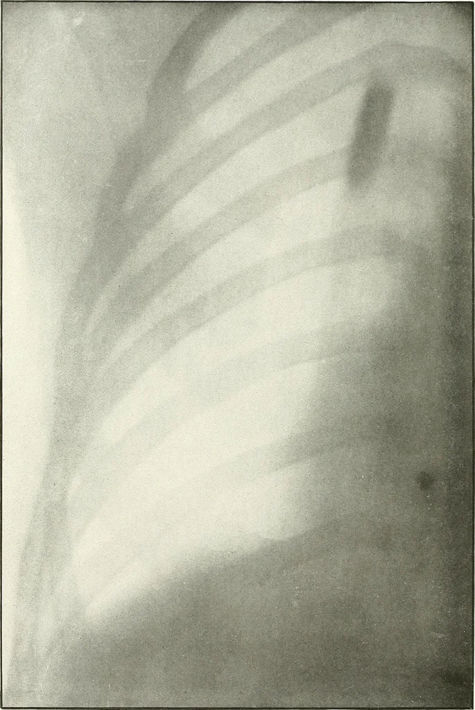 An illustration from Gunshot Roentgenograms : Acollection of Roentgenograms taken in Constantinople during the Turko-Balkan War, 1912-1913, illustrating some gunshot wounds in the Turkish Army, 1916, leaf 104