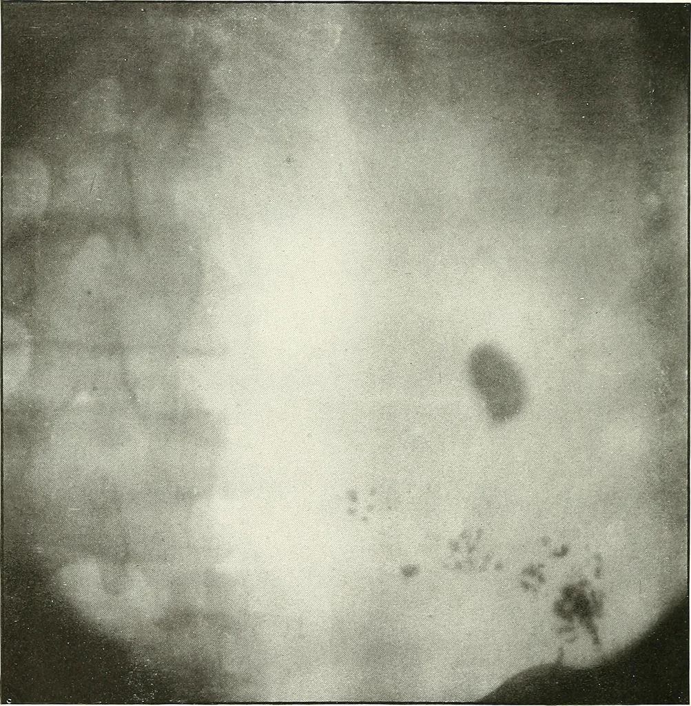 An illustration from Gunshot Roentgenograms : Acollection of Roentgenograms taken in Constantinople during the Turko-Balkan War, 1912-1913, illustrating some gunshot wounds in the Turkish Army, 1916, leaf 106
