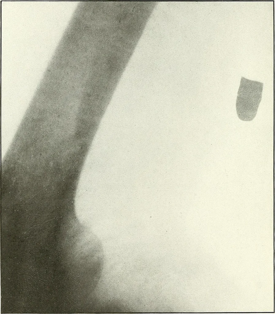 An illustration from Gunshot Roentgenograms : Acollection of Roentgenograms taken in Constantinople during the Turko-Balkan War, 1912-1913, illustrating some gunshot wounds in the Turkish Army, 1916, leaf 114
