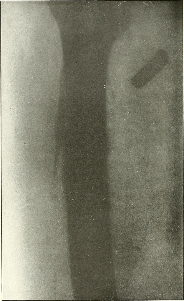 An illustration from Gunshot Roentgenograms : Acollection of Roentgenograms taken in Constantinople during the Turko-Balkan War, 1912-1913, illustrating some gunshot wounds in the Turkish Army, 1916, leaf 120