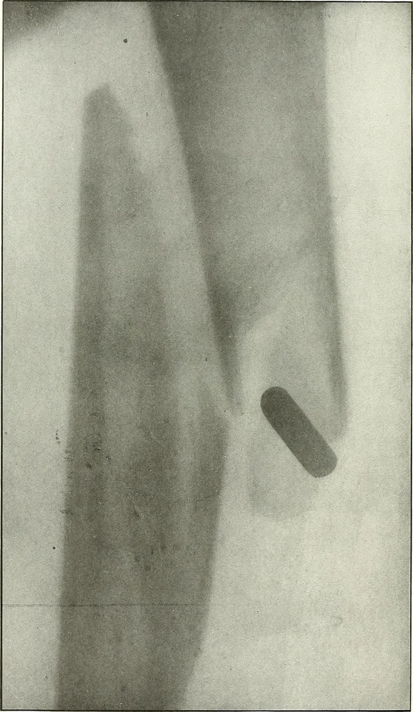 An illustration from Gunshot Roentgenograms : Acollection of Roentgenograms taken in Constantinople during the Turko-Balkan War, 1912-1913, illustrating some gunshot wounds in the Turkish Army, 1916, leaf 126