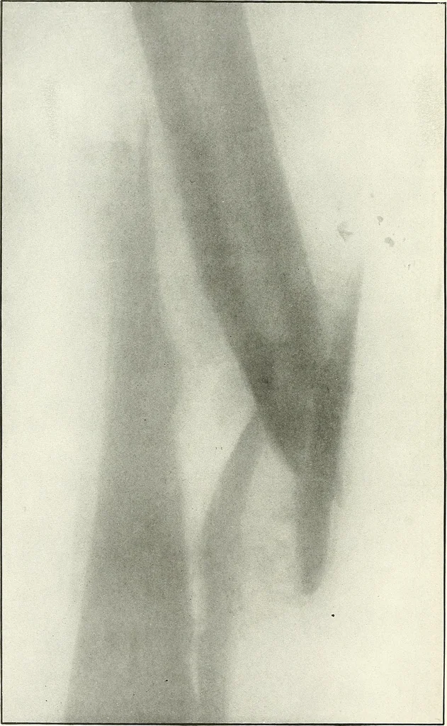 An illustration from Gunshot Roentgenograms : Acollection of Roentgenograms taken in Constantinople during the Turko-Balkan War, 1912-1913, illustrating some gunshot wounds in the Turkish Army, 1916, leaf 128