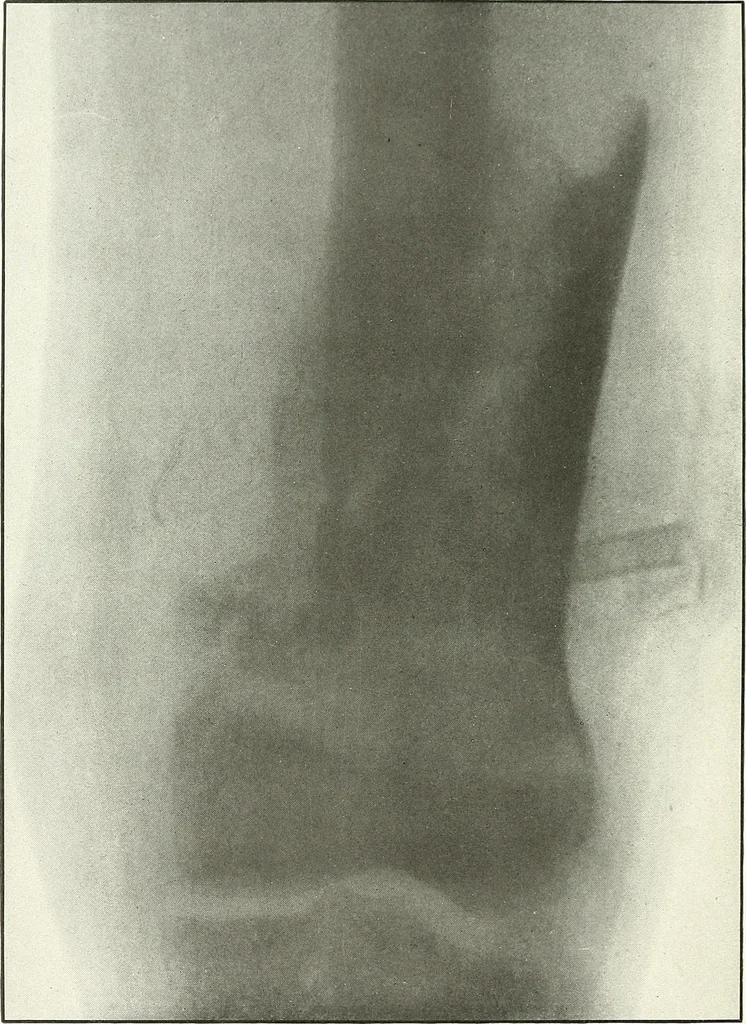 An illustration from Gunshot Roentgenograms : Acollection of Roentgenograms taken in Constantinople during the Turko-Balkan War, 1912-1913, illustrating some gunshot wounds in the Turkish Army, 1916, leaf 130