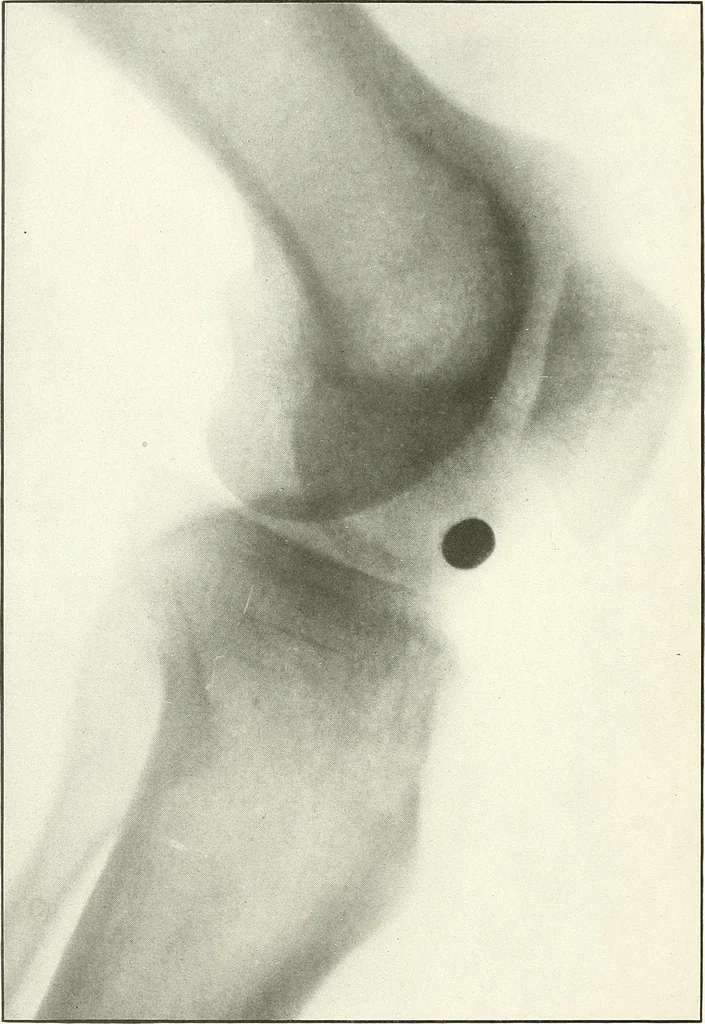 An illustration from Gunshot Roentgenograms : Acollection of Roentgenograms taken in Constantinople during the Turko-Balkan War, 1912-1913, illustrating some gunshot wounds in the Turkish Army, 1916, leaf 132