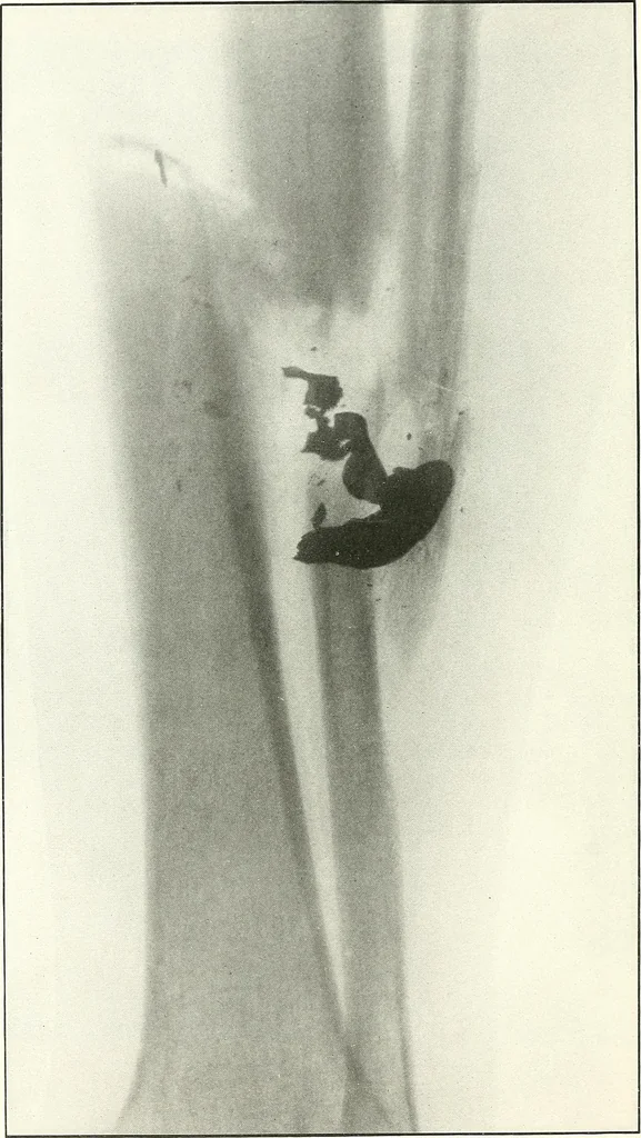 An illustration from Gunshot Roentgenograms : Acollection of Roentgenograms taken in Constantinople during the Turko-Balkan War, 1912-1913, illustrating some gunshot wounds in the Turkish Army, 1916, leaf 134