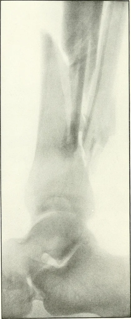 An illustration from Gunshot Roentgenograms : Acollection of Roentgenograms taken in Constantinople during the Turko-Balkan War, 1912-1913, illustrating some gunshot wounds in the Turkish Army, 1916, leaf 136